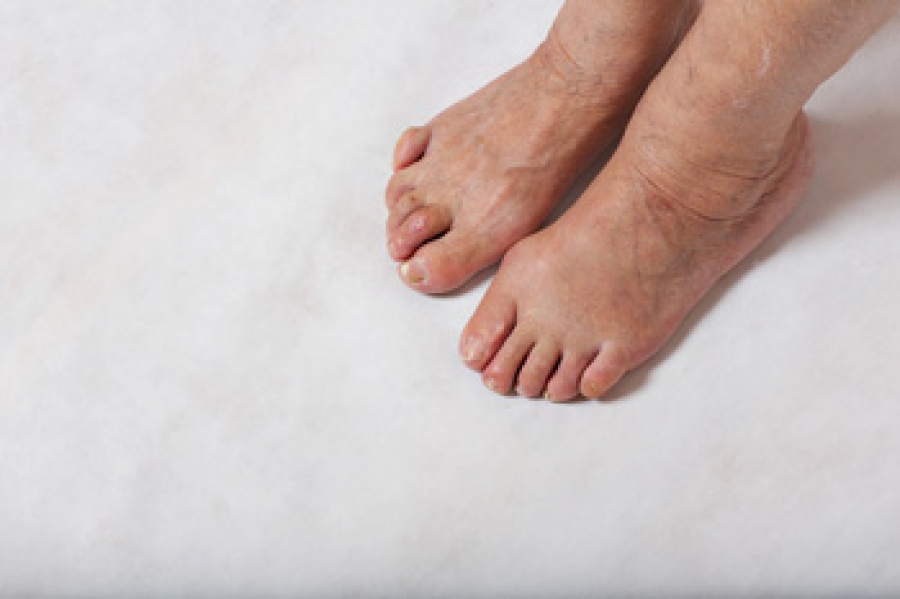 Crooked Toes: Types, Causes, and Treatment