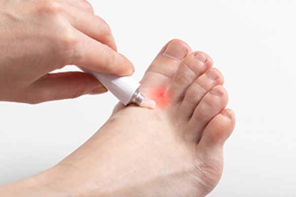 Athlete's Foot or Tinea Pedis - Best Diabetes Hospital in Kerala